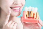 how-do-you-clean-dental-implants-920x613-1.jpg