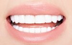 porcelain-veneers-cost.jpg