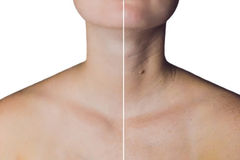 Botox For Neck | Non-Surgical Neck Lift And Band Treatment