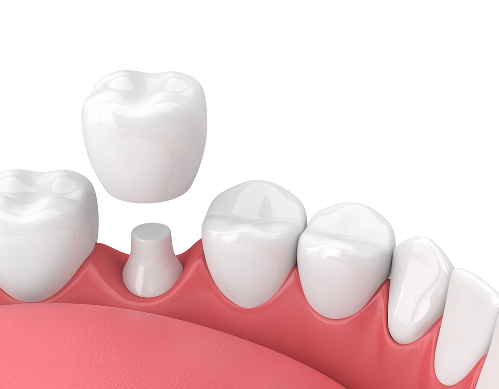 What is a Dental Crown and Do I Need One? - West Bell Dental Care