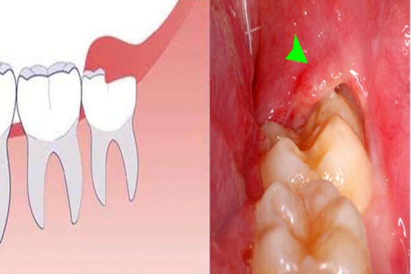 Cắt lợi trùm răng khôn giá bao nhiêu? Có đau và nguy hiểm không?