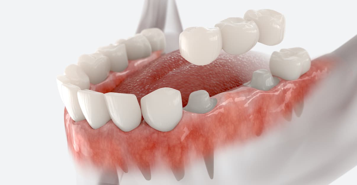 How Long Do Dental Crowns Usually Last? | Caldwell, Bills, Petrilli & West