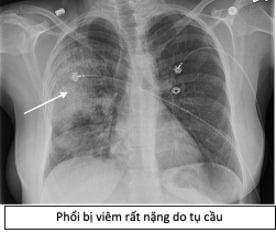 Bác sĩ BV Đại học Y Dược tiết lộ 1 cửa ngõ giúp vi khuẩn tấn công phổi rất ít người biết - Ảnh 1.