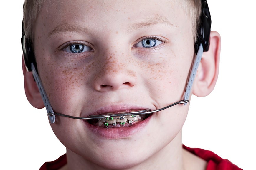 What Is Orthodontic Headgear and How is it Used?